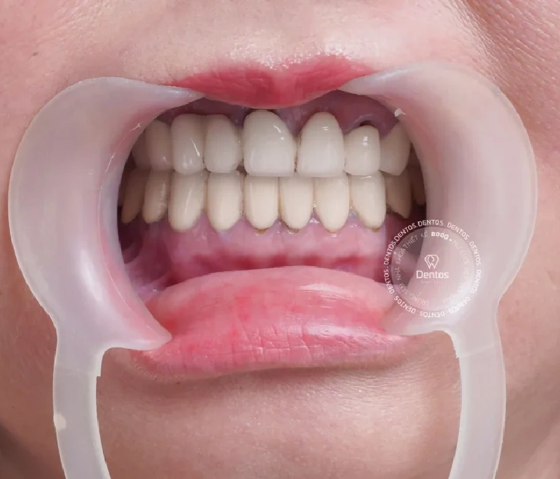 Hậu quả bọc răng sứ giá rẻ: 7 tác hại khủng khiếp bạn cần biết